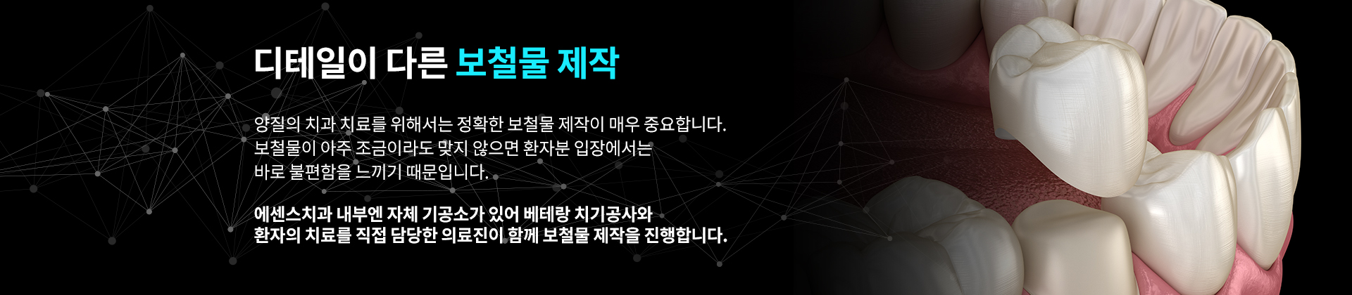 디테일이 다른 보철물